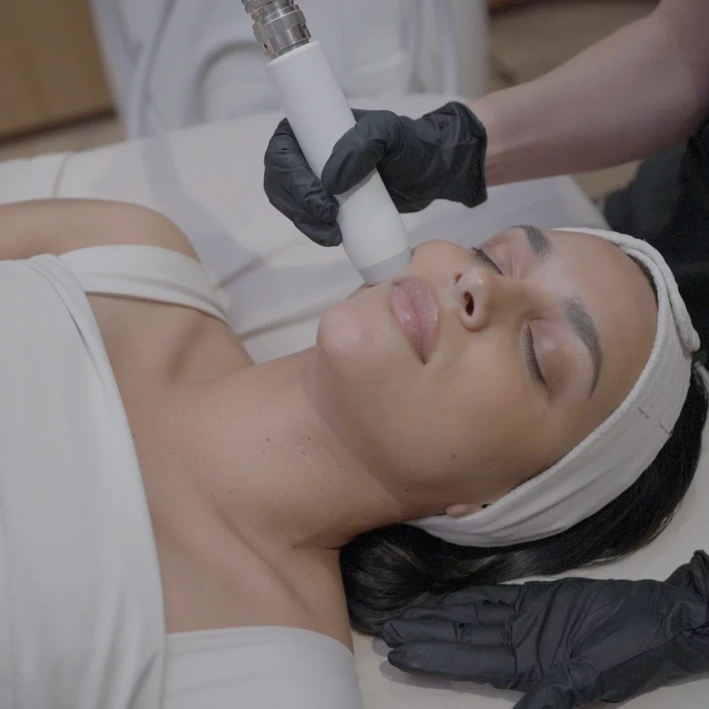 T-Shape 2 facial treatment on the cheek at iCRYO New Braunfels